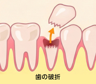 歯の破折