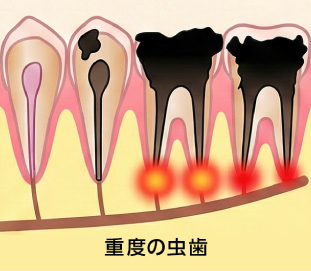 重度の虫歯