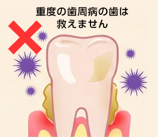重度の歯周病