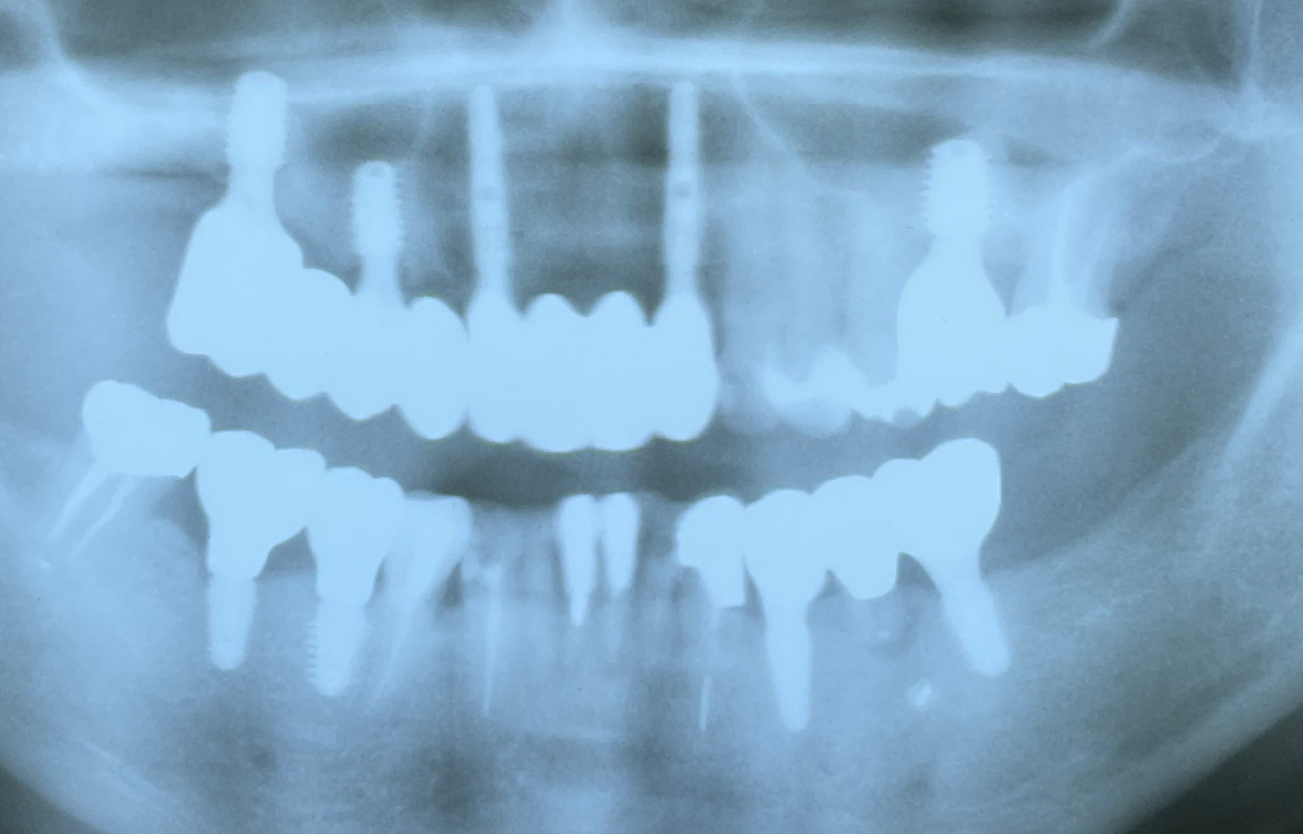 9本のインプラント