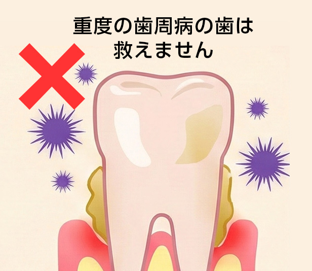 6重度の歯周病は救えません